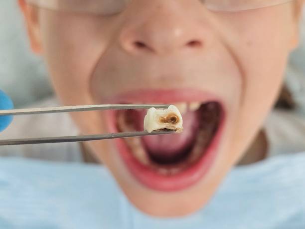 Best Emergency Treatment for Toothache in Towanda, KS